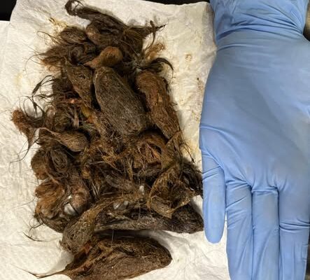 На Волині зі шлунка 7-річної дівчинки витягли 700 грамів волосся 