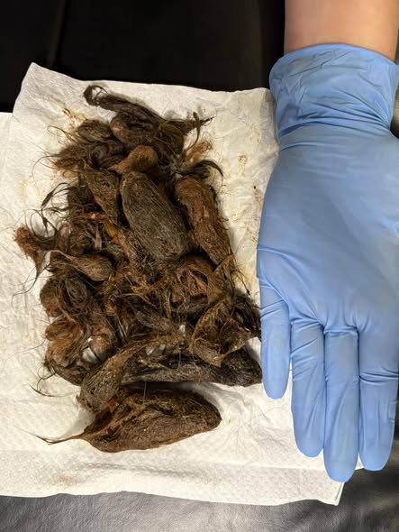 На Волині зі шлунка 7-річної дівчинки витягли 700 грамів волосся 